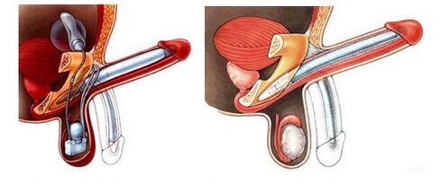 Prostesis zakar dengan prostesis kembung (kiri) dan plastik (kanan)